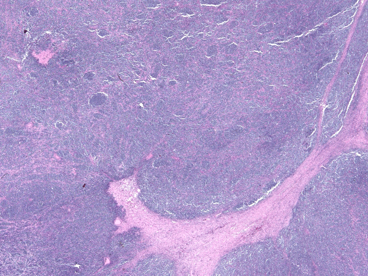 Retroperitoneal mass, low power